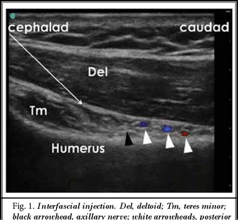 Ultrasound Guided Block Of The Axillary Nerve A Prospective