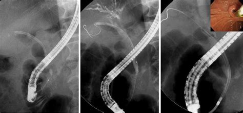 A Bile Duct Plastic Stent Migrated Into The Bile Duct A Download