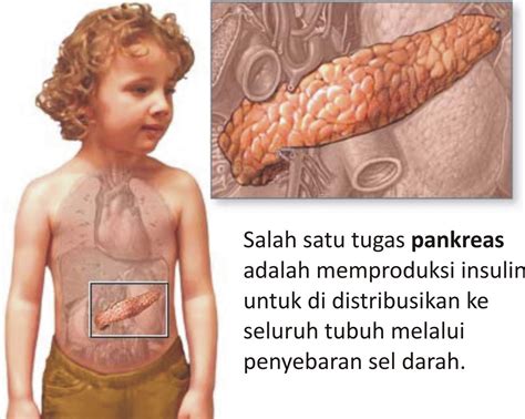 Hingga sekarang penyakit diabetes masih menjadi penyakit yang banyak menyerang warga di indonesia. Tipe Diabetes Mellitus Penyebab Kencing Manis | Cara ...