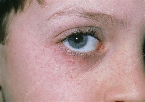 Purpura Rash On Childs Face After Vomiting Stock Image M2400222