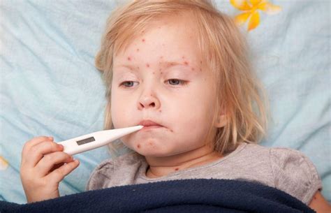 Chicken Pox Vaccinations At Cadham Pharmacy Glenrothes Fife Cadham