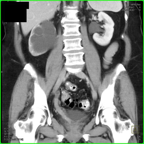 Bladder Cancer Obstructing The Right Ureter Genitourinary Case