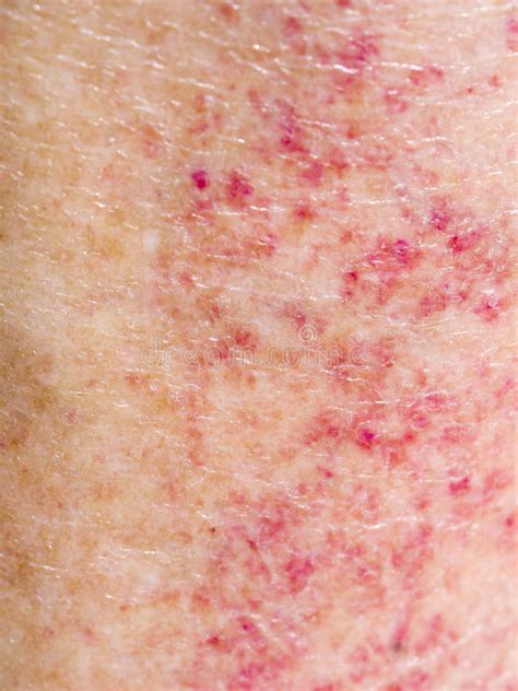 Sun Adverse Reaction Allergy Red Rash On Legs Detail Closeup Stock