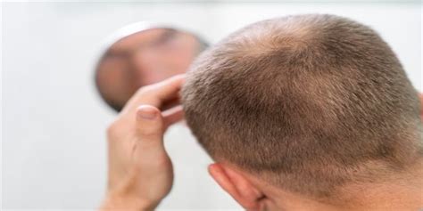 does testosterone cause hair loss asmed hair transplant