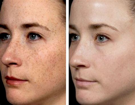 Fraxel Laser Resurfacing Costs And Side Effects Age Spot Removal