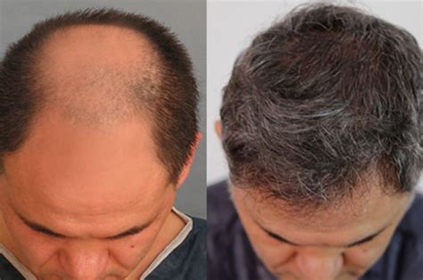 Natural Restoration Unveiling The Benefits Of Fue Hair Transplant