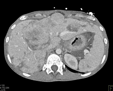 Metastatic Colon Cancer With Liver Metastases And Carcinomatosis
