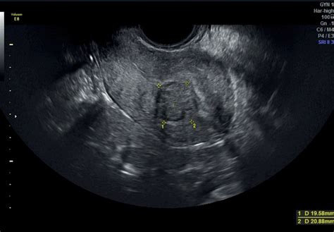Chapter 4 Sonographic Assessment Of Uterine Fibroids And Adenomyosis