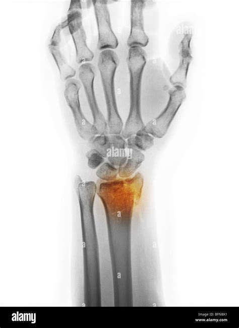 Left Wrist Distal Radius Fracture