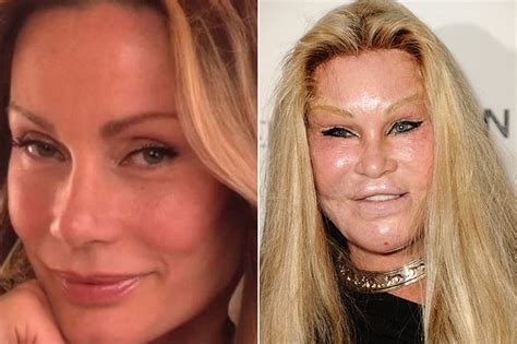 Celebs Who Are Unrecognizable After Having Plastic Surgery Page 8 Of