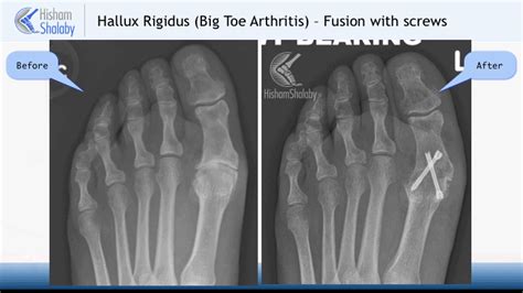 Big Toe Fusion Consultant Orthopaedics Edinburgh Mrshalaby