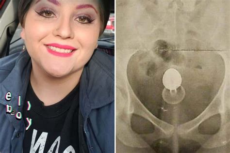 Mortified Woman Ends Up In Aande After Accident With A Sex Toy And Her