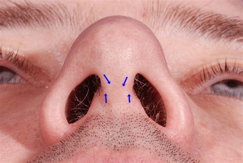 Rhinoplasty Nose Job San Diego Faq — Sky Facial Plastic Surgery