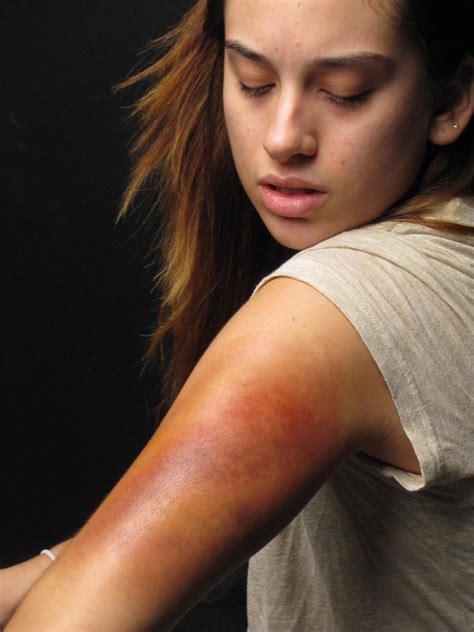 Maria Bruised Arm By Alisunshine16 On Deviantart