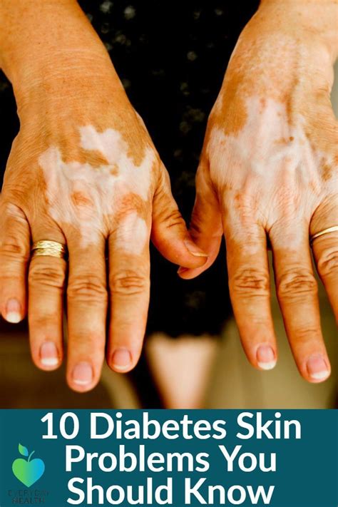 Diabetic Skin Rash Pictures Effective Health