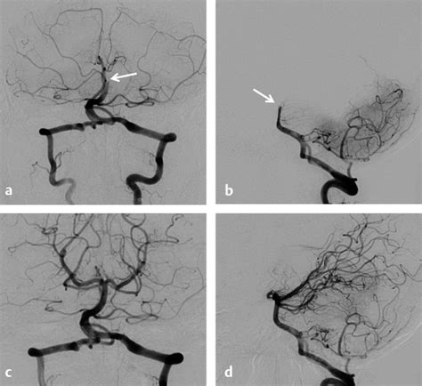 23 Brainstem Ischemia Stroke And Endovascular Revascularization Of