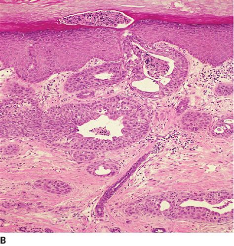 Epithelial And Melanocytic Tumors Of The Skin Veterian Key