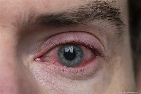 Researchers Identify Pink Eye As Possible Primary Symptom Of Covid 19