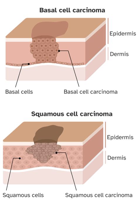 Basal And Squamous Cell Skin Cancers Seo Hub