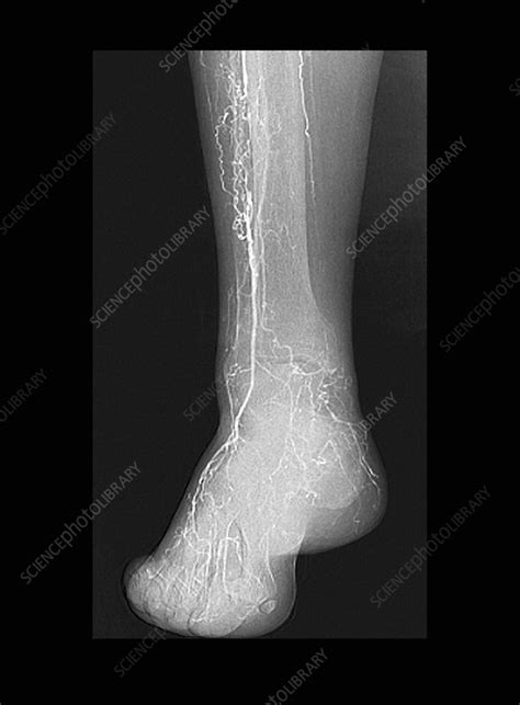 Thrombosis Angiogram Stock Image C0211908 Science Photo Library