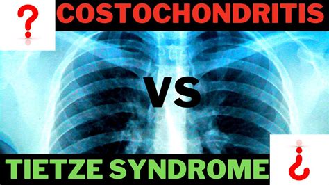 Tietze Syndrome Or Costochondritis Youtube