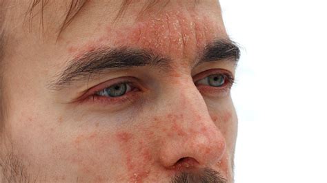 Psoriasis On The Face Symptoms Causes Treatment And More