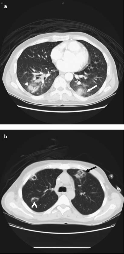 Chest Computed Tomography Scans Showing Typical Findings Of Ifi In Hsct