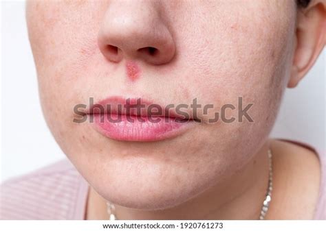 Cold Sore Herpes Under Nose Young Stock Photo 1920761273 Shutterstock
