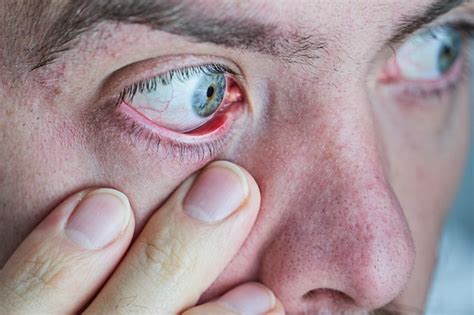 Close Up Of A Severe Bloodshot Red Eye Viral Blepharitis