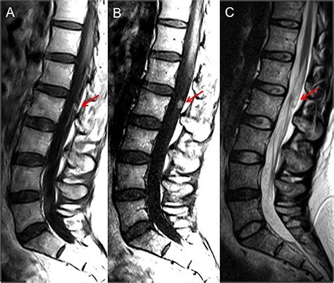 Cureus Isolated Lumbar Spinal Nerve Root Myxopapillary Ependymoma