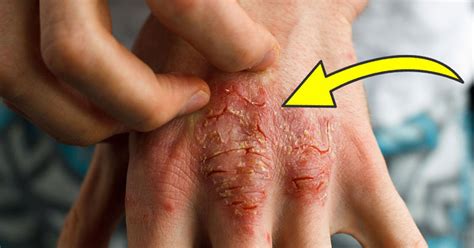 Causas Fundamentales Del Eczema Que Los Doctores Nunca Tratan