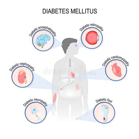 Diabetes Mellitus Type First Stock Vector Illustration Of Blue