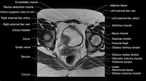 Mri Female Pelvis Anatomy Axial Image Pelvis Anatomy Rectus