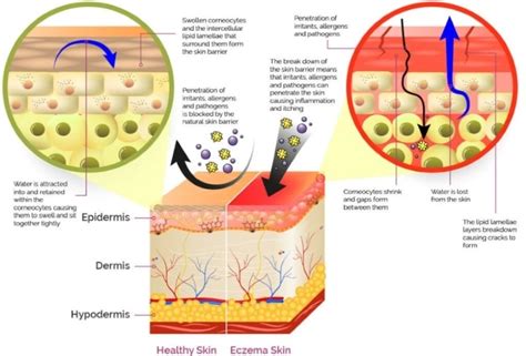 Eczema Types And Treatment Information Disabled World