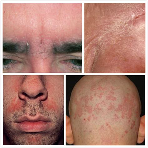 How To Treat Seborrheic Dermatitis On Face New Health Advisor