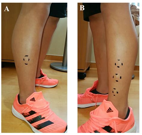 Medicina Free Full Text A Traumatic Neuroma Formation Following