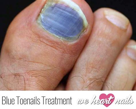 What Is The Cause Of Blue Toenails Discover How To Treat Blue Toenails