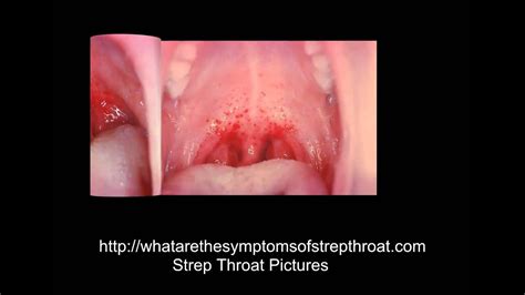 Strep Throat Pictures Youtube