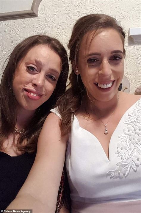 Mum Of Four Who Needed Both Legs Amputating After A House Fire Claims Accident Made Her Life