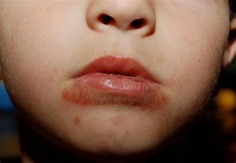 What Causes A Red Rash Around Your Lips Allergy Trigger