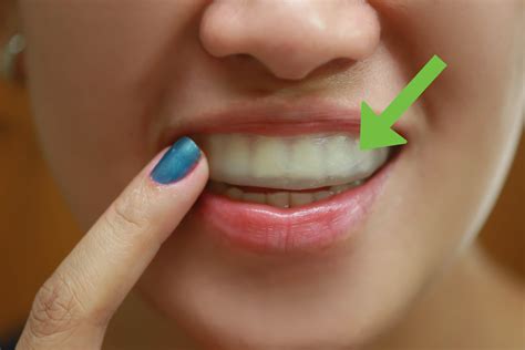 How To Make A Fake Retainer Out Of Wax 9 Steps With Pictures