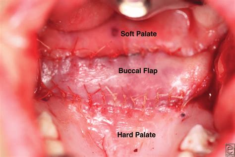 After Releasing The Soft Palate From The Hard Palate The Bilateral
