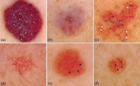 Frontiers Dermoscopic Features Summarization And Comparison Of Four