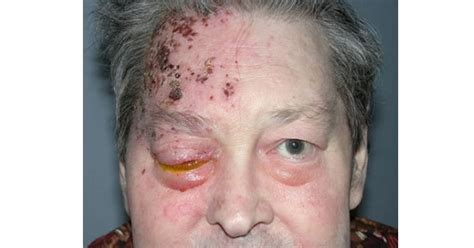 A diagnosis can usually be made based on the symptoms and the appearance of the rash, as well as through an examination of the eye. Herpes Zoster Ophthalmicus - www.medicoapps.org