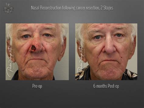 Skin Cancer Reconstruction Archives Page 2 Of 3 New Orleans Premier