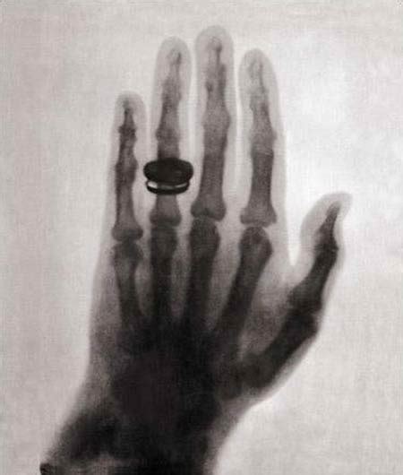 Wow Amazing And Interesting Worlds First X Ray 1895 Röntgens