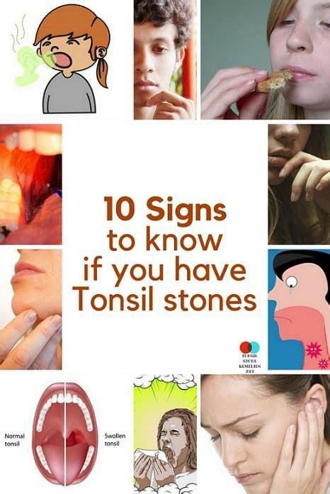Pin On Tonsil Stone Remedies