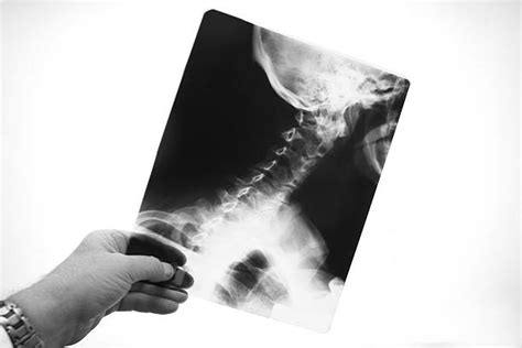 170 Cervical Intervertebral Disc Stock Photos Pictures And Royalty Free