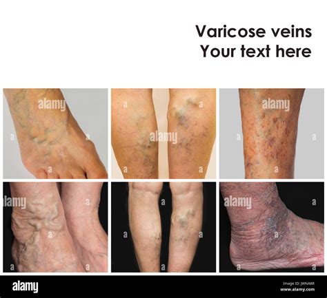 Collage From Images Of Varicose Veins Stock Photo Alamy