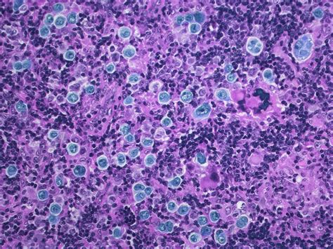 Large B Cell Lymphoma Lm Stock Image C0514735 Science Photo Library